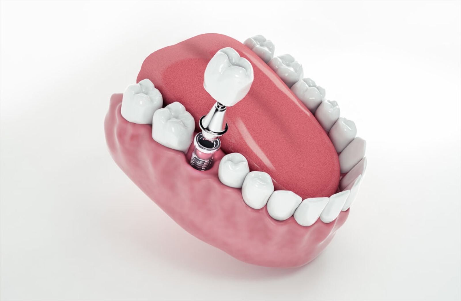 Implantes Dentários