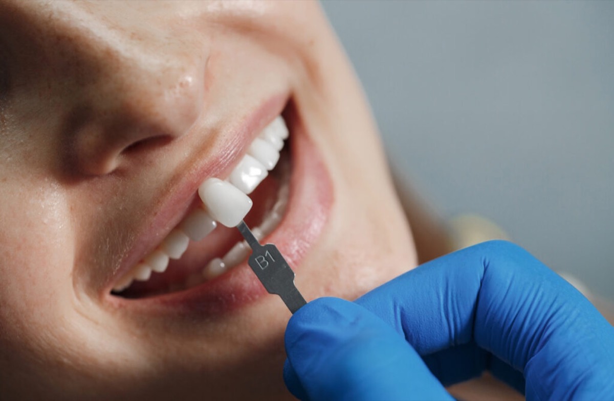 Lentes Dentárias